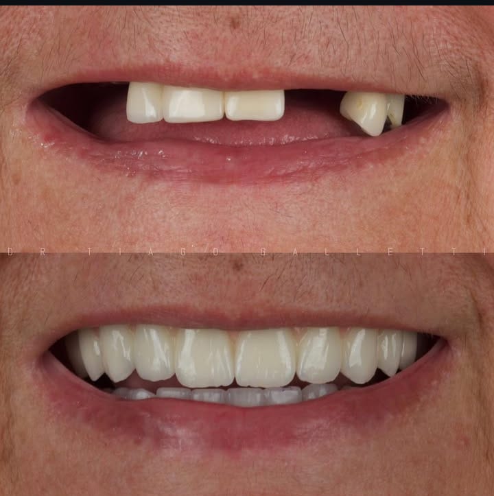 Caso 01 — antes e depois de reabilitação dentária anterior no IOG