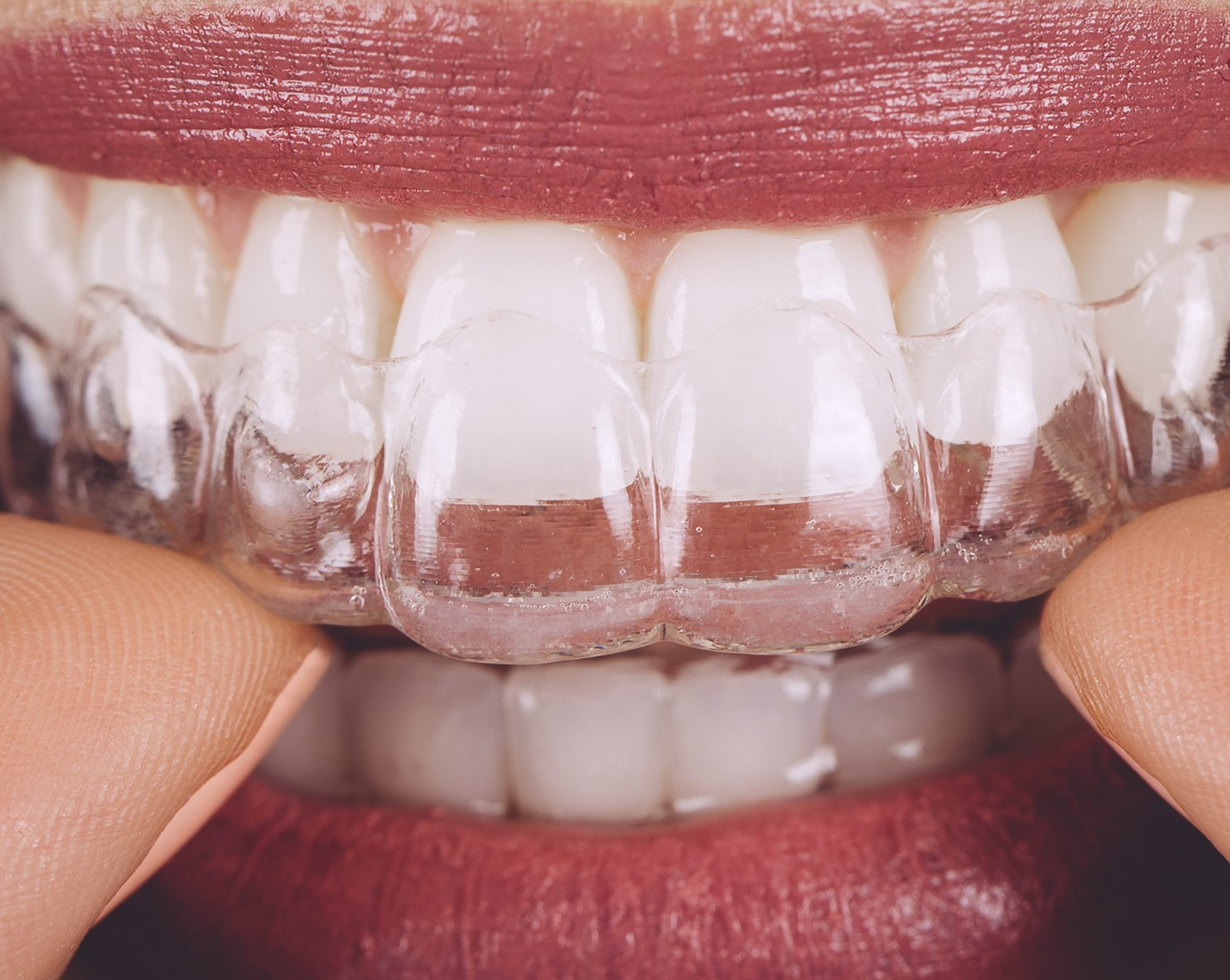 Invisalign